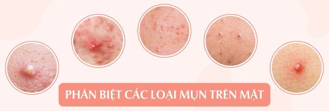 phân biệt các loại mụn