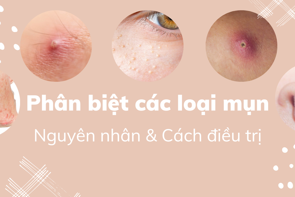 phân biệt các loại mụn