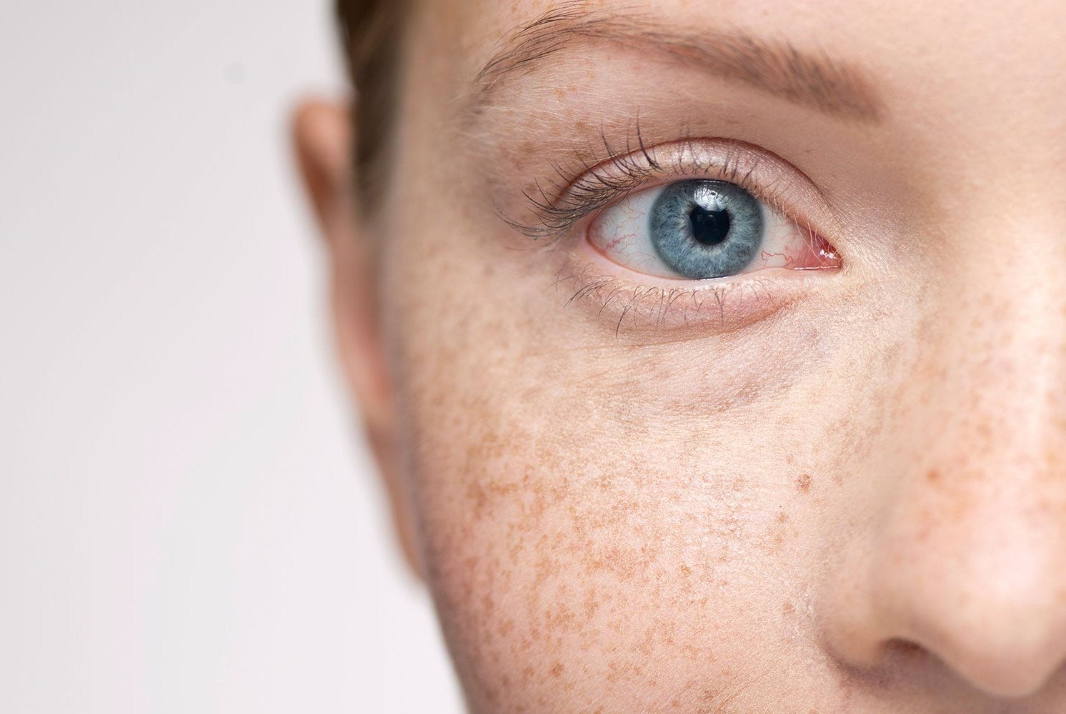 phân biệt nám và tàn nhang