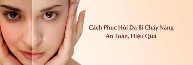 Cách phục hồi da bị cháy nắng