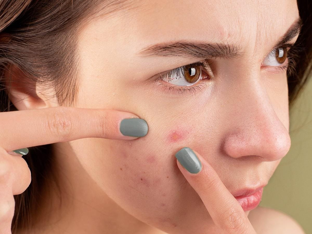 Tại sao việc nặn mụn ăn dưới da có thể gây ra vết thâm và sẹo?
