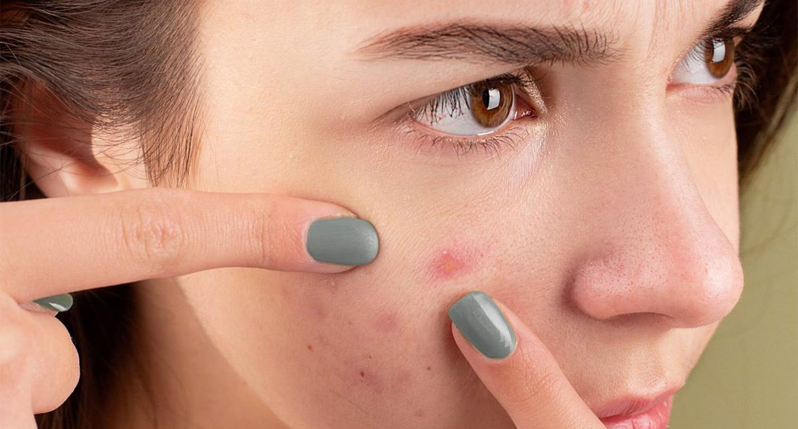 mụn bọc không đầu