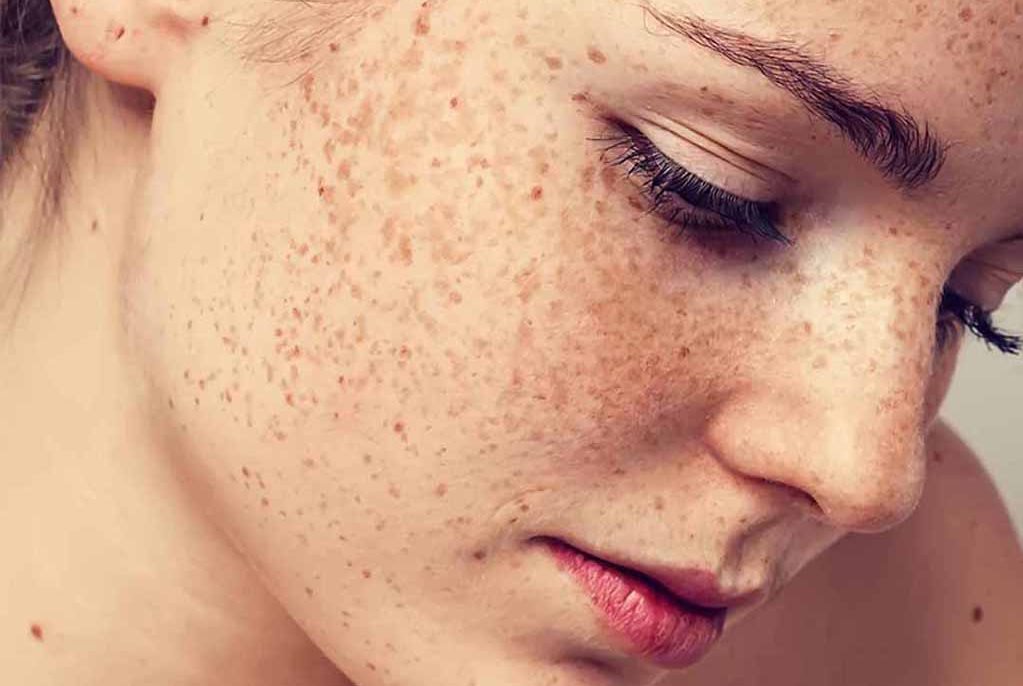 rối loạn sắc tố melenin