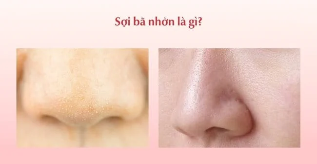 Sợi bã nhờn là gì?