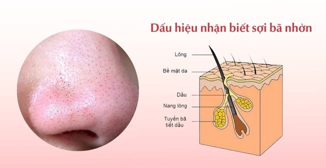 Dấu hiệu nhận biết sợi bã nhờn