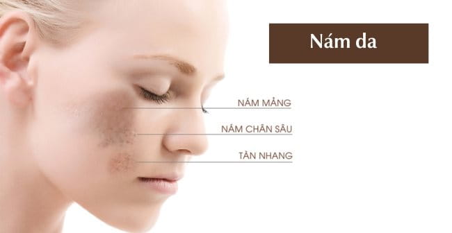Loại hình tăng sắc tố da mặt thường gặp: Nám da