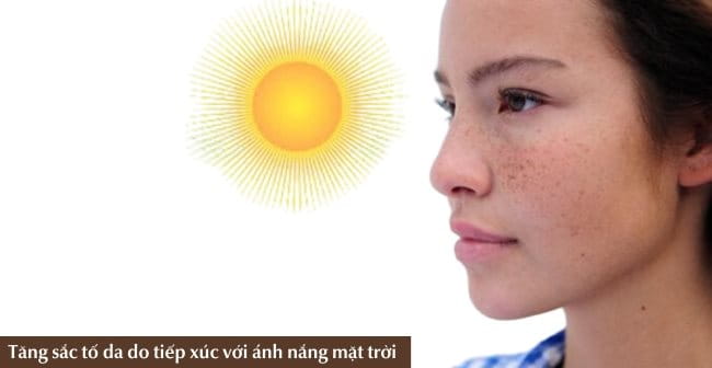 Tăng sắc tố da ở mặt do tiếp xúc với ánh nắng mặt trời 