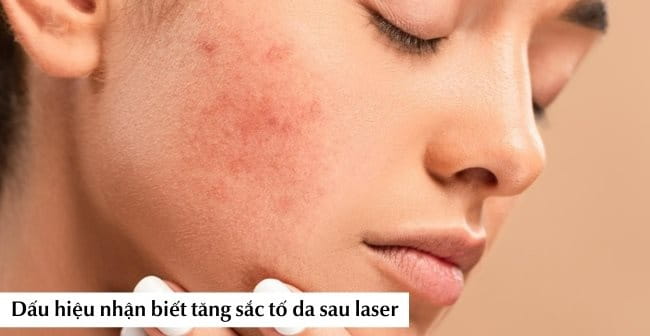 Tăng sắc tố sau laser gây ra những mảng da sậm màu