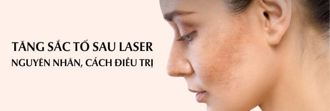 Vì sao tăng sắc tố sau laser? Cách điều trị hiệu quả