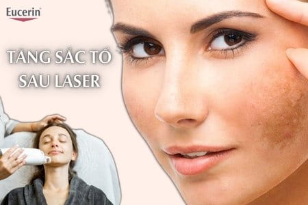 Tăng sắc tố sau laser do đâu? Cách điều trị hiệu quả
