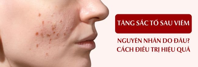 Tăng sắc tố sau viêm