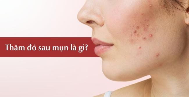 Thâm đỏ sau mụn là gì?