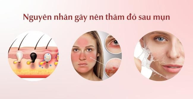 Nguyên nhân gây thâm đỏ sau mụn