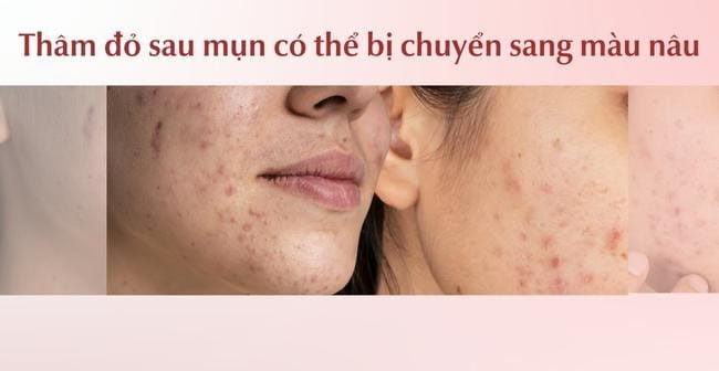 Các dạng thâm đỏ sau mụn