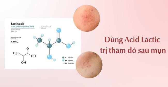 Dùng Acid Lactic trị thâm sau mụn