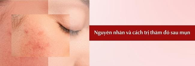 Thâm đỏ sau mụn: Nguyên nhân, cách điều trị hiệu quả