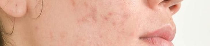 thâm mụn bao lâu thì hết