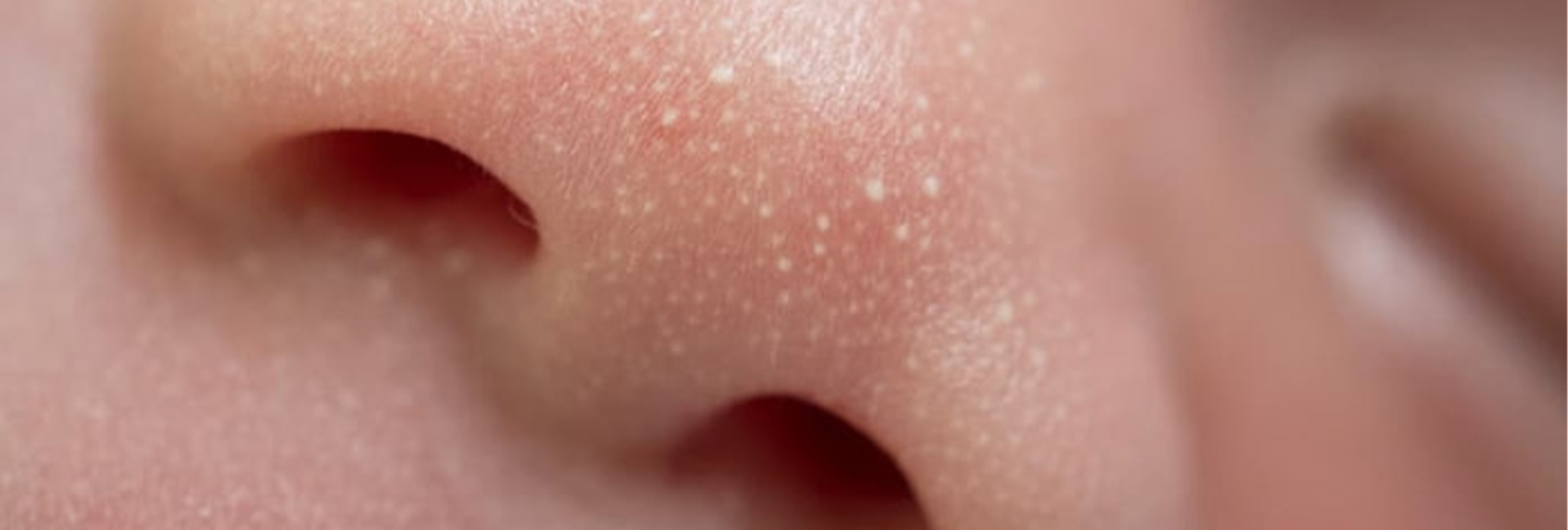 Cách Trị Mụn Đầu Trắng Hiệu Quả Dứt Điểm