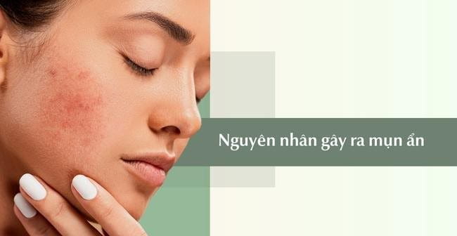 Mụn ẩn là do vi khuẩn, bụi bẩn tích tủ trong lỗ chân lông gây ra 