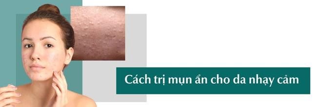 Tri mụn ẩn cho da nhạy cảm hiệu quả chuẩn Y khoa