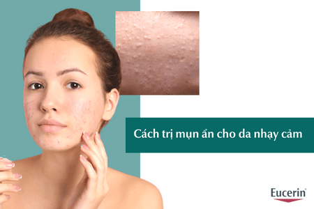 Trị mụn ẩn cho da nhạy cảm chuẩn Y khoa