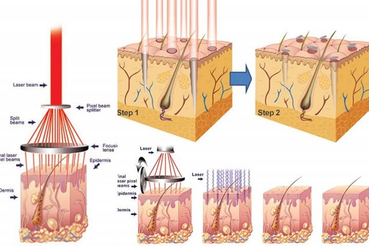 Điều trị mụn bằng laser Fractional CO2/PICO