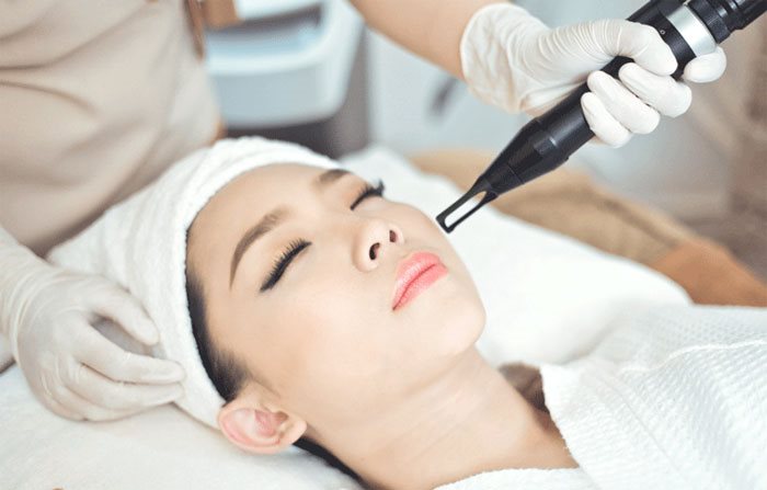 Trị nám bằng laser có hiệu quả không? Những thông tin bạn cần biết