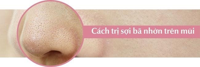 Cách trị sợi bã nhờn trên mũi an toàn, hiệu quả