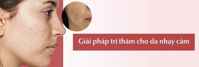 Cách trị thâm cho da nhạy cảm an toàn, hiệu quả
