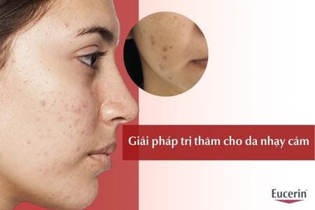 Giải pháp trị thâm cho da nhạy cảm an toàn, hiệu quả