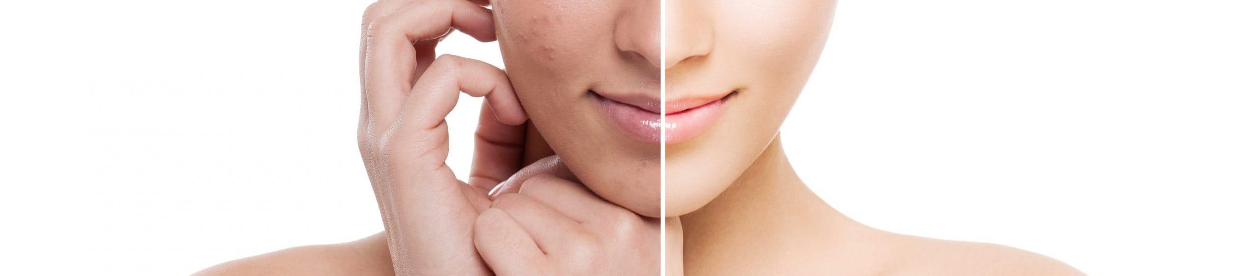 trị thâm mụn tại nhà