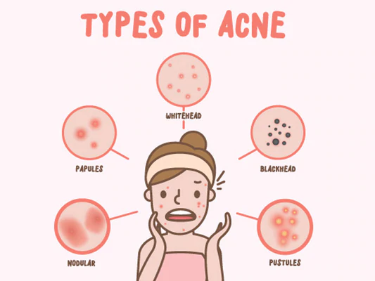 Types-of-Acne---Which-Acne-do-you-have