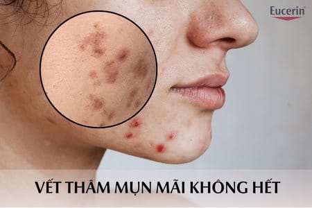 Vết thâm mụn mãi không hết phải làm sao? Nguyên nhân, cách điều trị