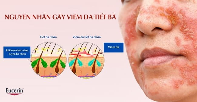 Nguyên nhân gây nên bệnh viêm da tiết bã