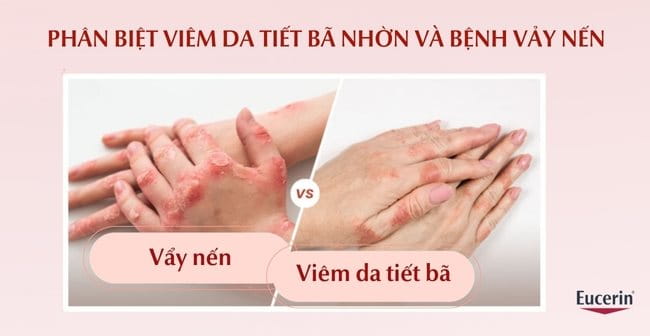 Sự khác biệt giữa viêm da tiết bã nhờn và bệnh vảy nến?