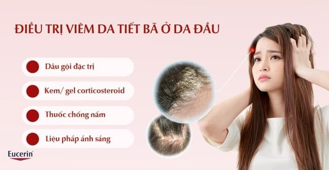 Điều trị viêm da tiết bã ở da đầu