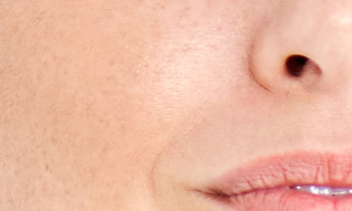 pigmentação no rosto