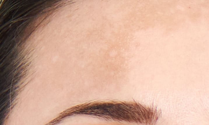 manchas de pigmentação