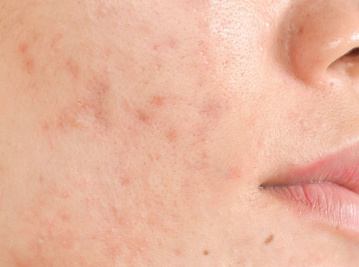 Pozápalová hyperpigmentácia