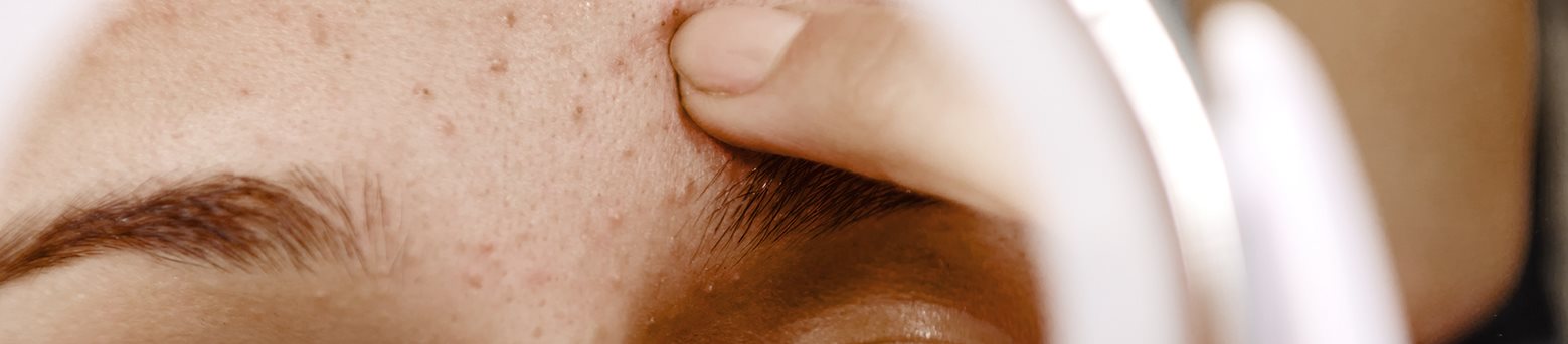 tipos de acne