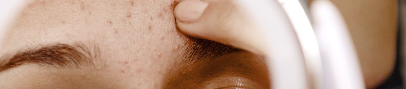 tipi di acne