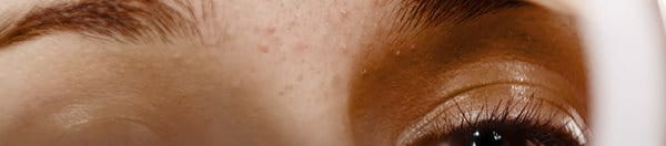 Acne comes in different types and form