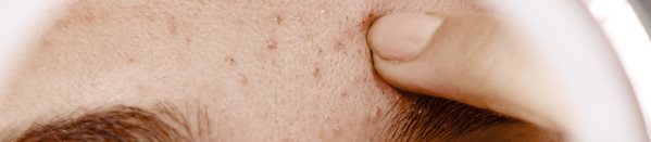 Acne comes in different types and form