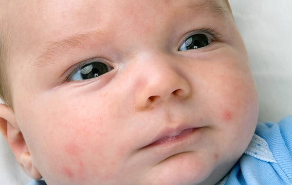 Acne on baby