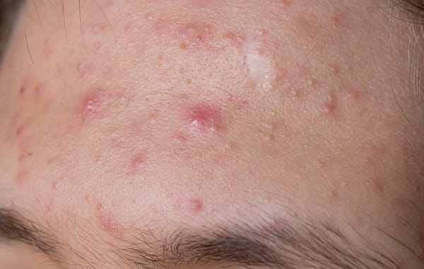 Acne papulopustulosa