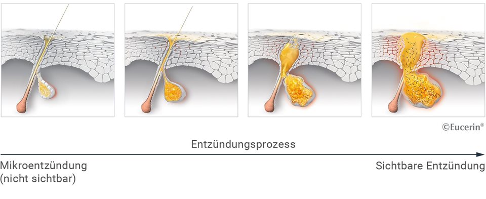 Wie entstehen Pickel und Mitesser? | Eucerin