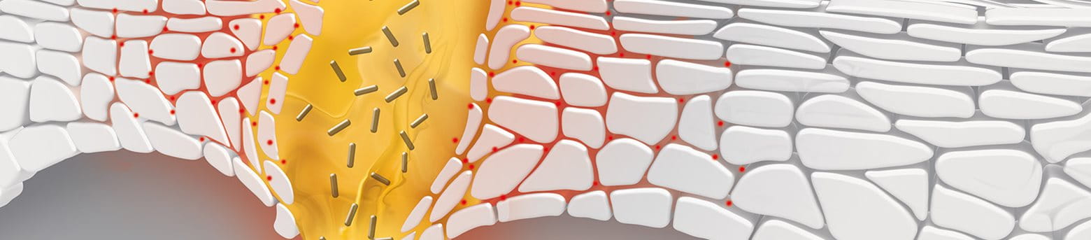 Schematische Abbildung Entstehung Akne