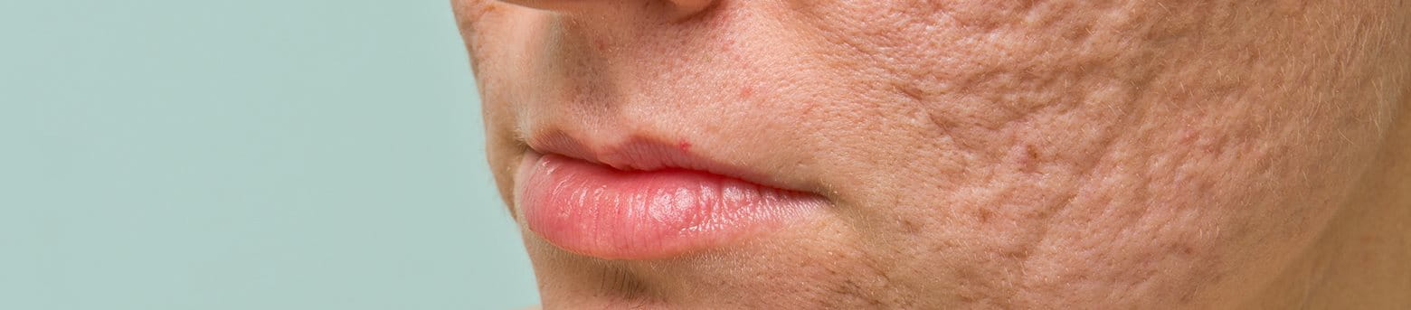 Tratamiento y eliminación de las cicatrices del acné