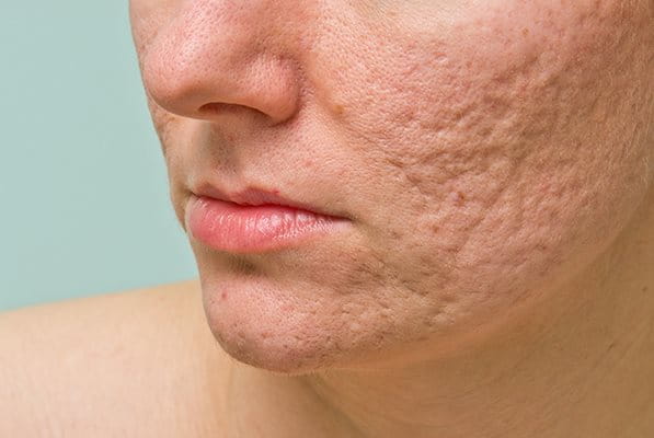 eliminare cicatrici acne