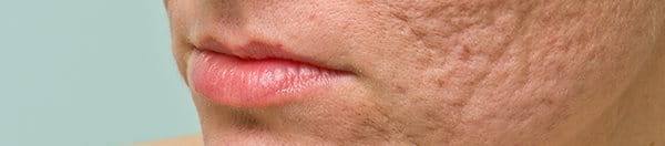 eliminare cicatrici acne